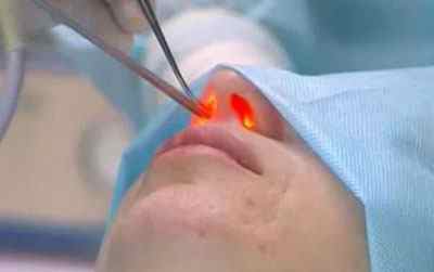 Що таке лазерна септопластика носової перегородки і як вона проводиться