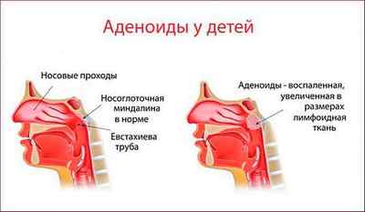 Що таке мигдалини в горлі, їх будова і функції