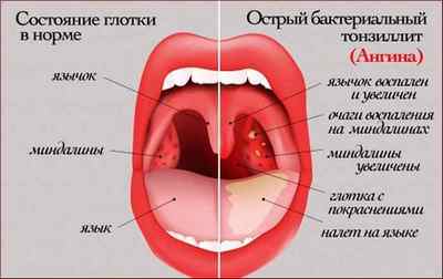 Що таке мигдалини в горлі, їх будова і функції