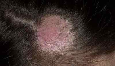 Що таке мікози волосистої частини голови і як його лікувати?