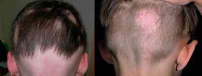 Що таке мікози волосистої частини голови і як його лікувати?