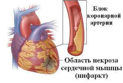Що таке інфаркт легені, його причини, симптоми, лікування і наслідки