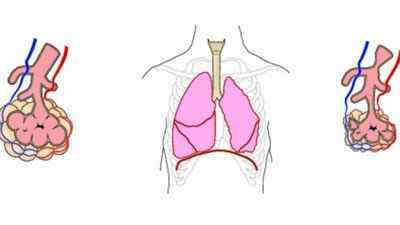 Що таке інфаркт легені, його причини, симптоми, лікування і наслідки