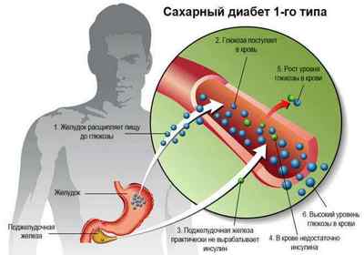 Що таке інсулін в організмі людини: гормон підшлункової залози
