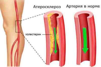 Що таке облітеруючий атеросклероз судин нижніх кінцівок і як лікувати