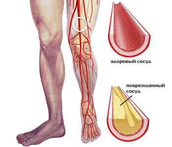 Що таке облітеруючий ендартеріїт судин нижніх кінцівок і лікування