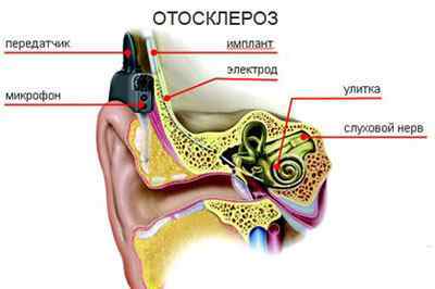Що таке отосклероз вуха, його симптоми і лікування