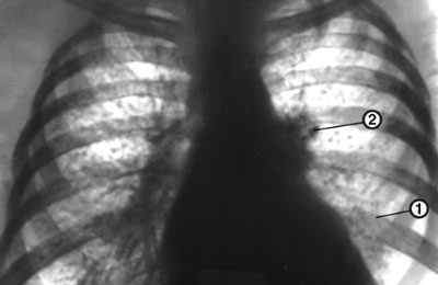 Що таке петрифікати в легенях і як їх лікувати