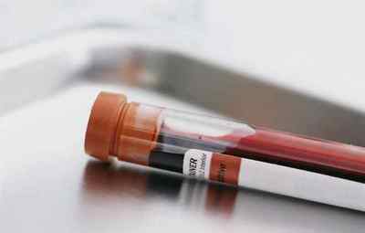 Що таке протромбіновий час в аналізі крові і небезпека відхилень від норми