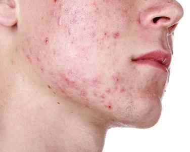 Що таке псоріаз на обличчі, які стадії захворювання існують і чим його лікувати?