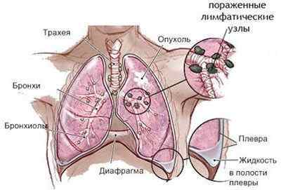 Що таке саркома легенів, її симптоми і методи лікування