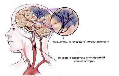 Що таке ішемічна хвороба головного мозку