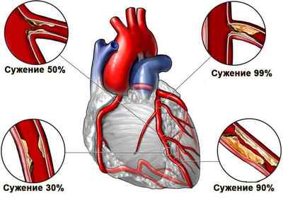 Що таке ішемічна хвороба і лікування серця