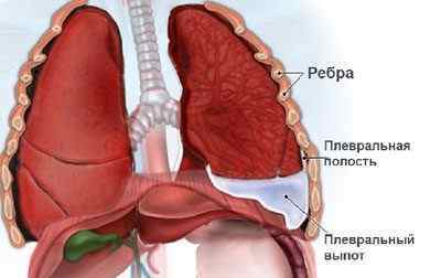 Що таке спайки в легенях, ніж вони небезпечні і як їх лікувати