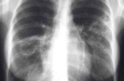 Що таке спайки в легенях, ніж вони небезпечні і як їх лікувати