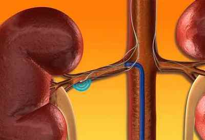 Що таке стеноз ниркової артерії і чим він небезпечний
