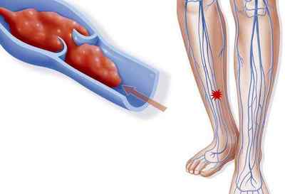 Що таке тромбоемболія нижніх кінцівок