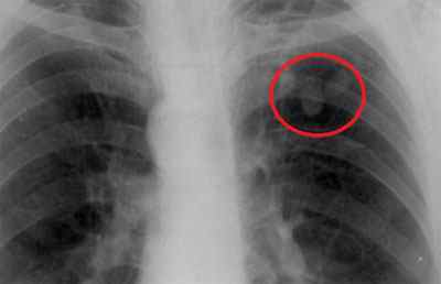Що таке туберкулёма легких і заразна вона