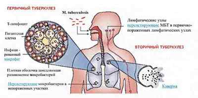 Що таке туберкульоз легенів, історія відкриття, цікаві факти