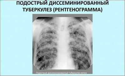 Що таке туберкульоз легенів: визначення, симптоми, ознаки