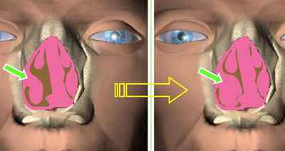 Що таке вазотомія носових раковин і як її проводять