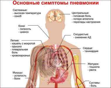Що таке запалення легенів (пневмонія) - ознаки, симптоми, лікування