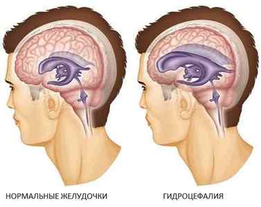 Що таке зовнішня гідроцефалія головного мозку, її лікування