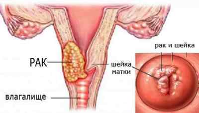 Що являє собою рак шийки матки -РШМ