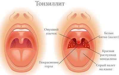 Що значить пухке горло у дорослого і як його лікувати