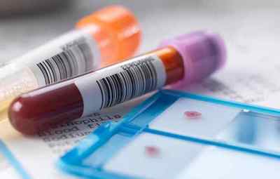 Що значить сильне підвищення гормонів АТ ТПО в крові