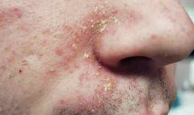 Себорейний дерматит на обличчі: причини і лікування