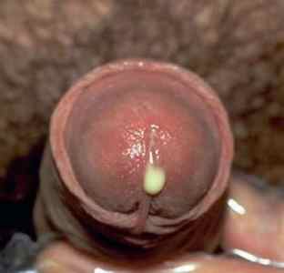 Сечостатеві інфекції у чоловіків: список, симптоми і лікування.