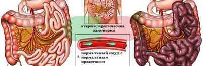 Ішемія кишечника: симптоми і лікування патології