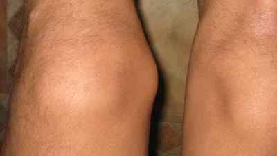 Шишка на коліні: що це може бути, шишки на ногах під шкірою вище коліна у дитини і дорослого, причини мякої шишки | Ревматолог