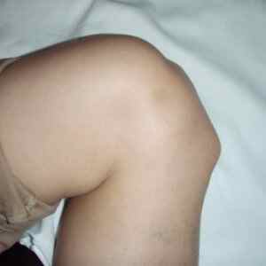 Шишка на коліні: що це може бути, шишки на ногах під шкірою вище коліна у дитини і дорослого, причини мякої шишки | Ревматолог