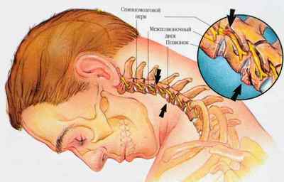 Шийний синдром (шийна мігрень або синдром Барре-Льеу): що це таке, симптоми і лікування | Ревматолог