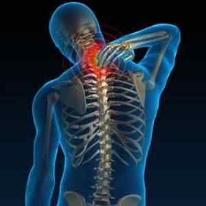 Шийно-плечовий синдром: що таке, симптоми і лікування народними засобами | Ревматолог