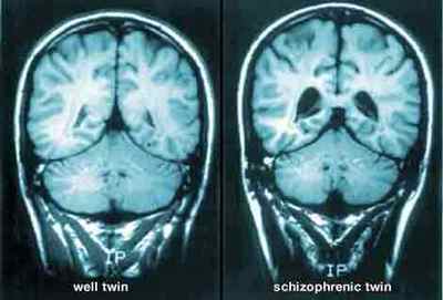 Шизофренія: класифікація та методи лікування