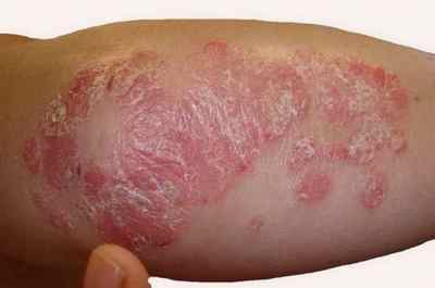 Шкірні захворювання: що таке псоріаз і як його лікувати і чим? Як боротися з хворобою в домашніх умовах. Реальні фото