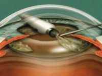 Штучне око для людини: види протезування, створення, як витягнути очної протез