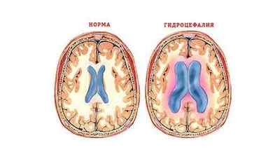 Шунтування головного мозку при гідроцефалії, наслідки операції