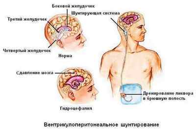 Шунтування головного мозку при гідроцефалії, наслідки операції