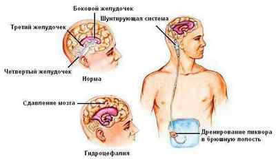 Шунтування головного мозку при гідроцефалії /судин