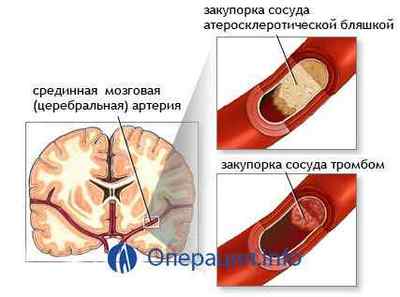 Шунтування головного мозку при гідроцефалії /судин