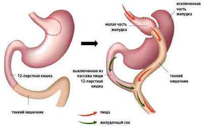 Шунтування шлунка (гастрошунтірованіе): операція і її результат