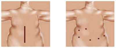 Шунтування шлунка (гастрошунтірованіе): операція і її результат