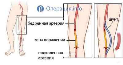 Шунтування судин нижніх кінцівок, ніг: артерій і вен