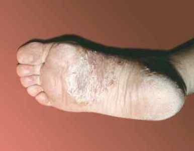 Швидке і ефективне лікування псоріазу на стопах ніг, фото і важливі нюанси