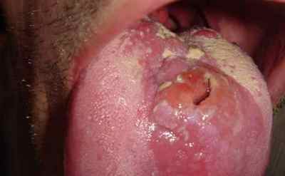 Сифіліс горла: симптоми і ознаки.