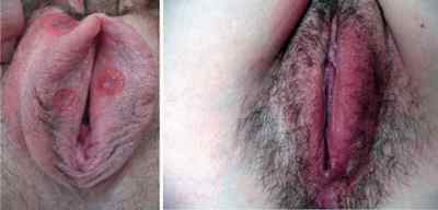 Сифіліс на статевих губах: характерні симптоми.